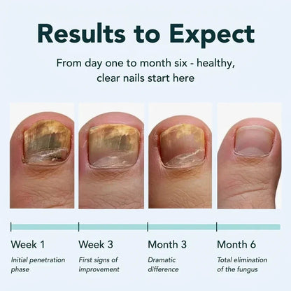 🌟Antifungal Pen💅Powerful results for thick, yellowing, dry, and cracked nails—see the difference in healthy, beautiful nails Dlosyvo®